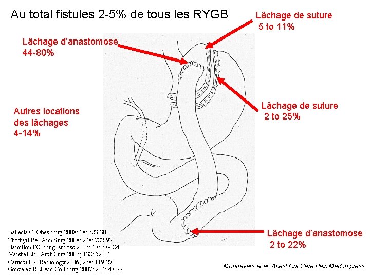 Au total fistules 2 -5% de tous les RYGB Lâchage de suture 5 to