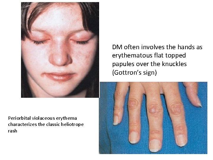 DM often involves the hands as erythematous flat topped papules over the knuckles (Gottron’s