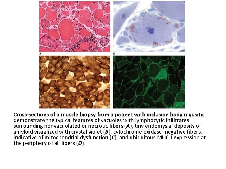Cross-sections of a muscle biopsy from a patient with inclusion body myositis demonstrate the