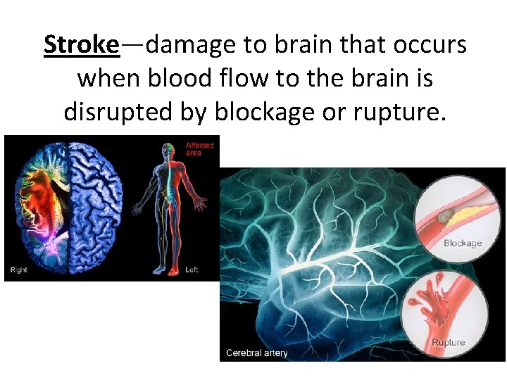 Stroke—damage to brain that occurs when blood flow to the brain is disrupted by