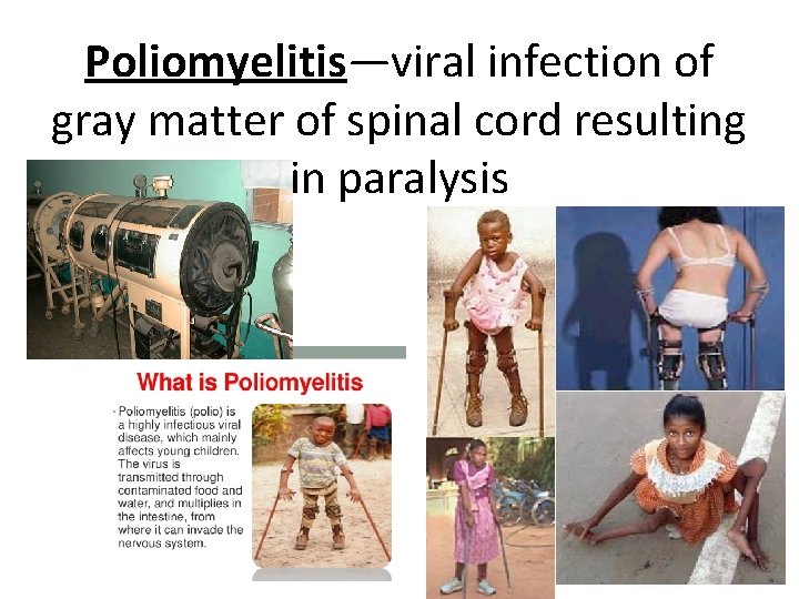 Poliomyelitis—viral infection of gray matter of spinal cord resulting in paralysis 