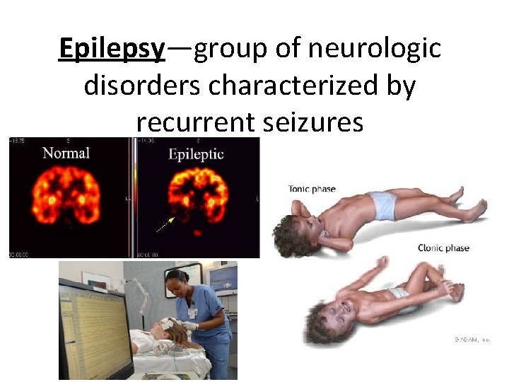 Epilepsy—group of neurologic disorders characterized by recurrent seizures 