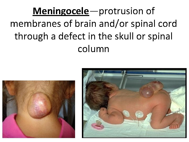 Meningocele—protrusion of membranes of brain and/or spinal cord through a defect in the skull