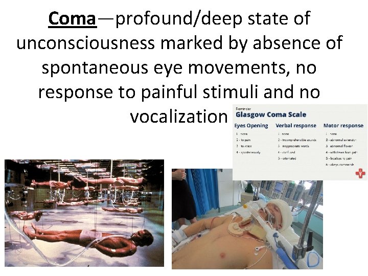 Coma—profound/deep state of unconsciousness marked by absence of spontaneous eye movements, no response to