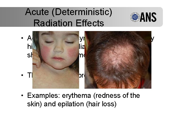 Acute (Deterministic) Radiation Effects • Acute radiation symptoms are caused by high levels of