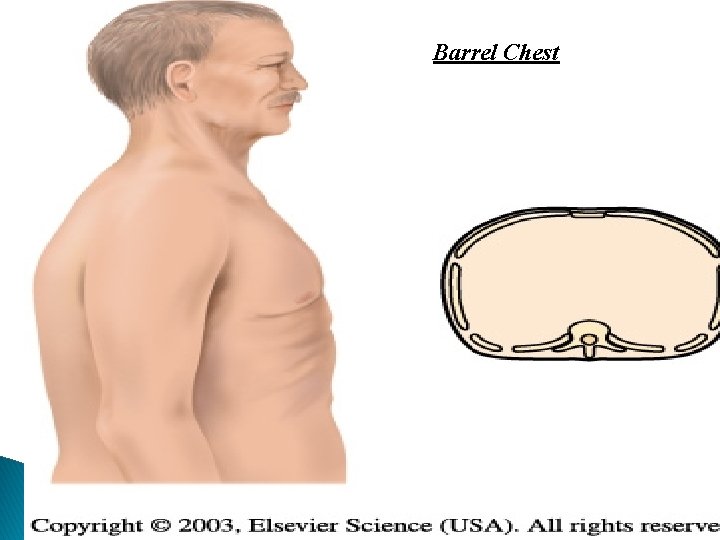 Barrel Chest 