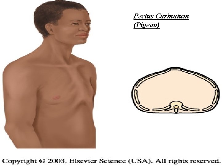 Pectus Carinatum (Pigeon) 