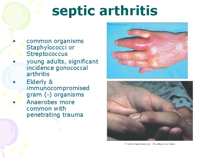 septic arthritis • • common organisms Staphylococci or Streptococcus young adults, significant incidence gonococcal