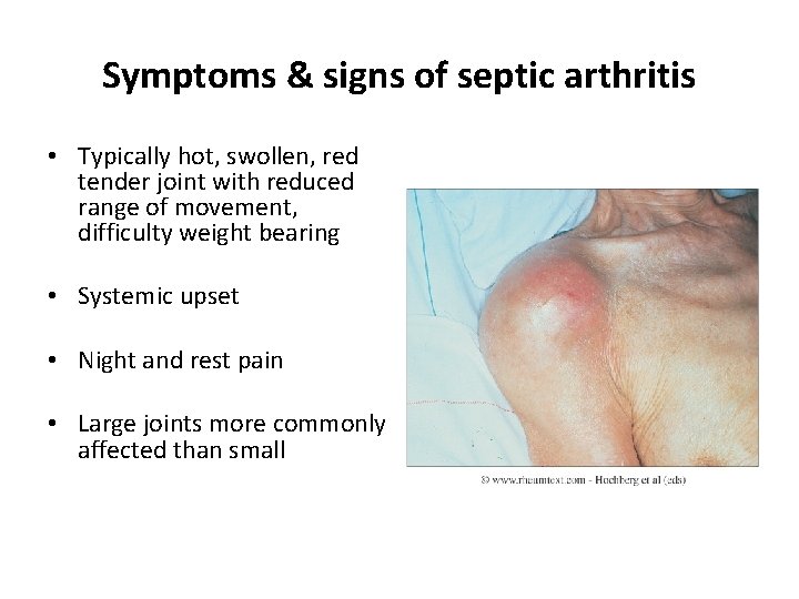 Symptoms & signs of septic arthritis • Typically hot, swollen, red tender joint with
