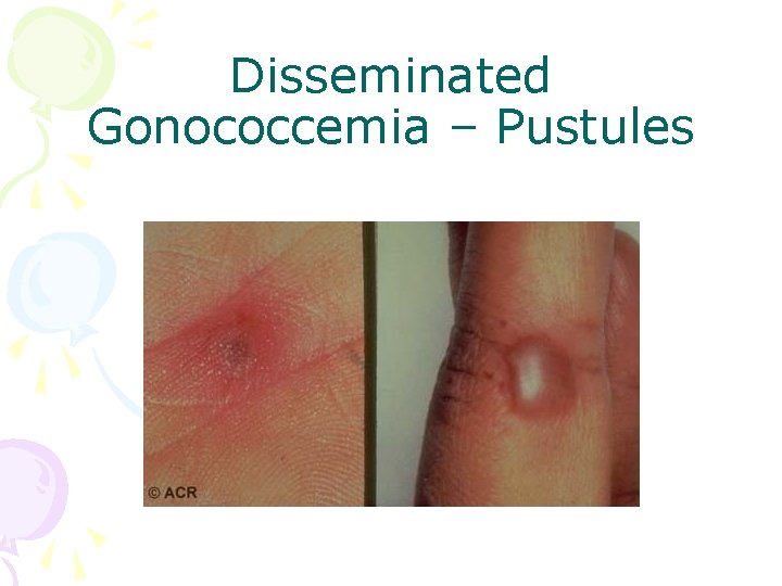 Disseminated Gonococcemia – Pustules 