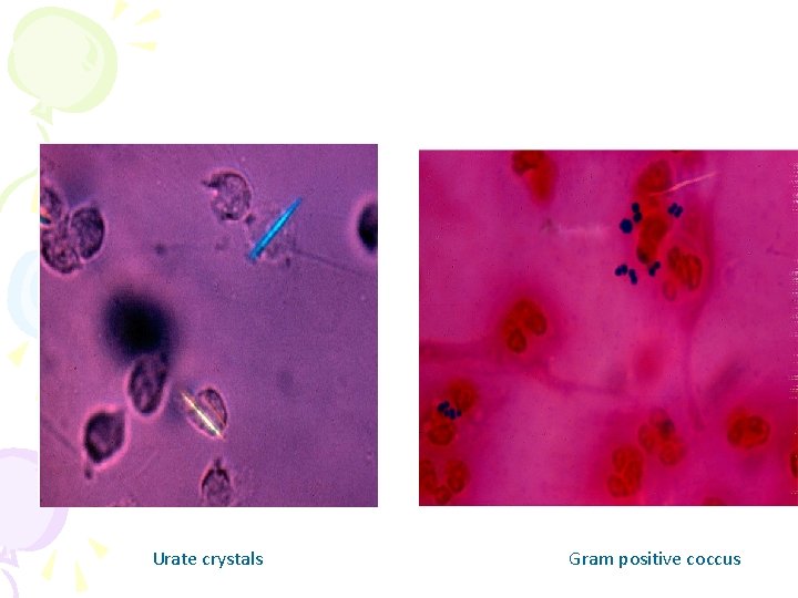 Urate crystals Gram positive coccus 