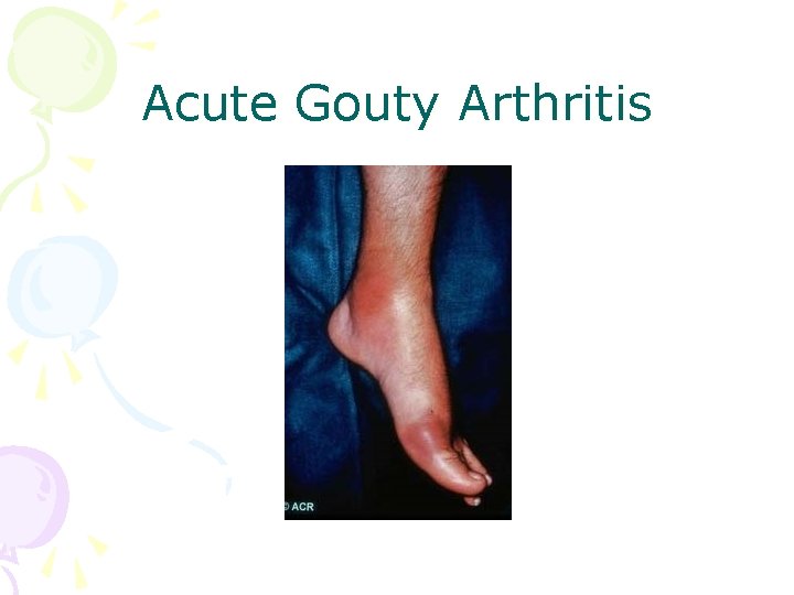 Acute Gouty Arthritis 