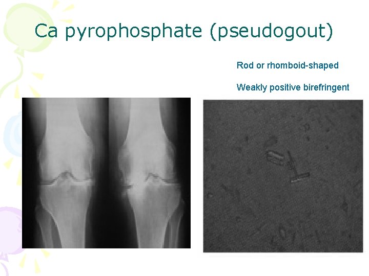 Ca pyrophosphate (pseudogout) Rod or rhomboid-shaped Weakly positive birefringent 