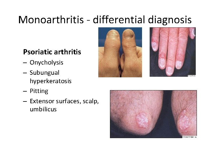 Monoarthritis - differential diagnosis Psoriatic arthritis – Onycholysis – Subungual hyperkeratosis – Pitting –