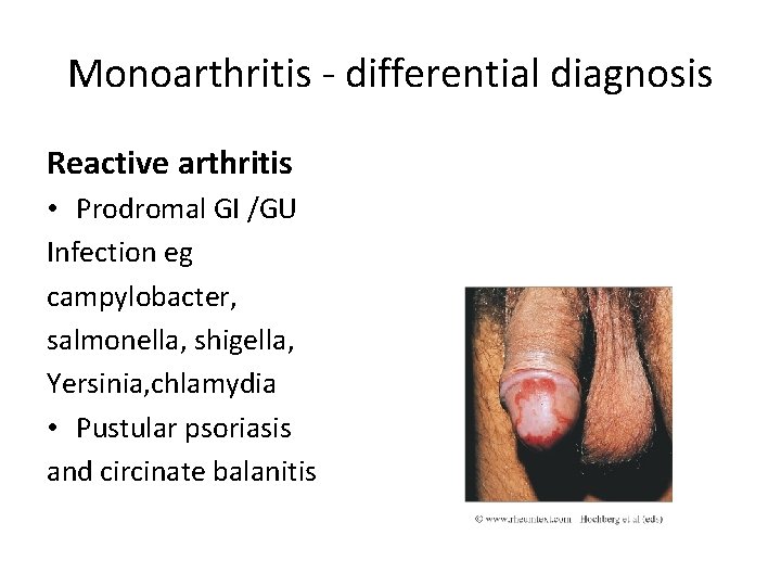 Monoarthritis - differential diagnosis Reactive arthritis • Prodromal GI /GU Infection eg campylobacter, salmonella,