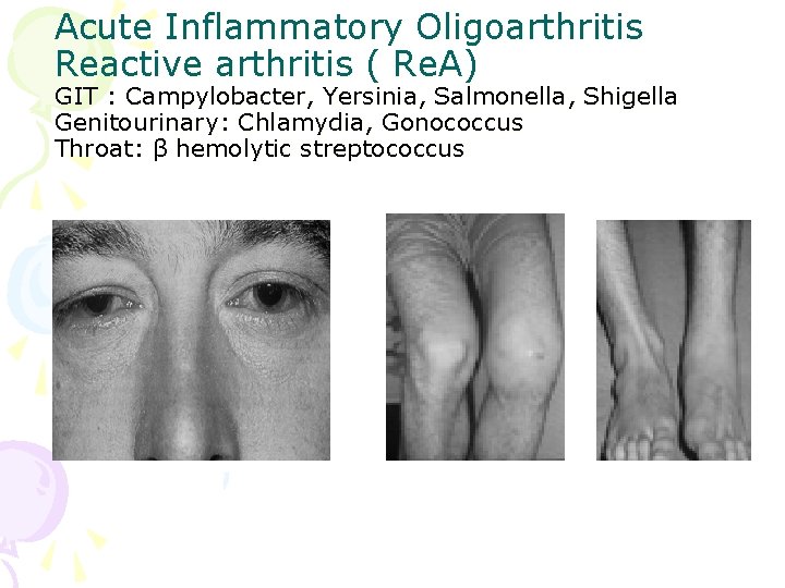 Acute Inflammatory Oligoarthritis Reactive arthritis ( Re. A) GIT : Campylobacter, Yersinia, Salmonella, Shigella