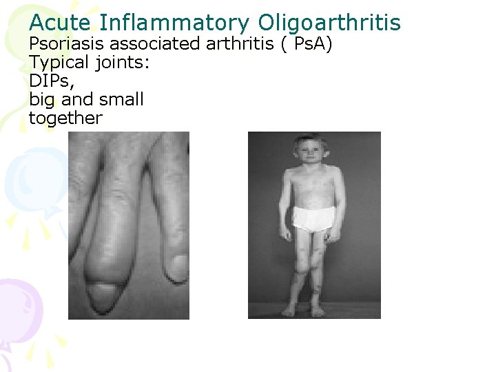 Acute Inflammatory Oligoarthritis Psoriasis associated arthritis ( Ps. A) Typical joints: DIPs, big and