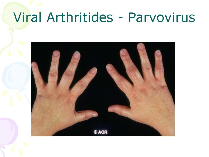 Viral Arthritides - Parvovirus 