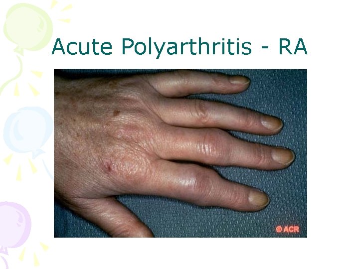 Acute Polyarthritis - RA 