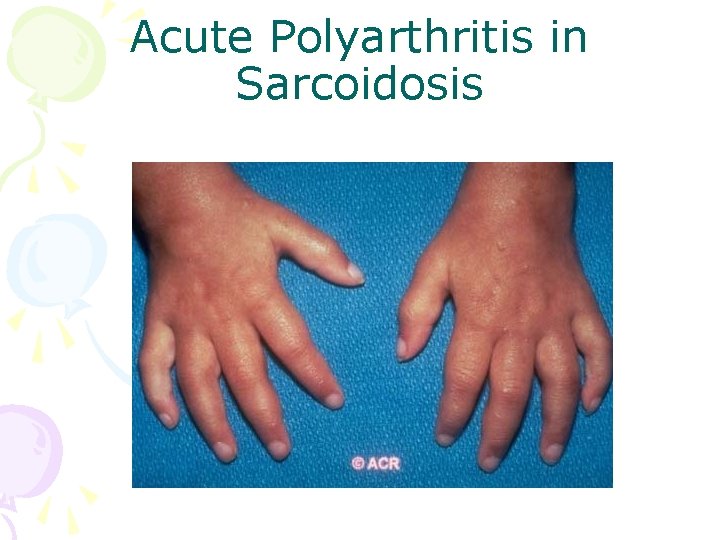 Acute Polyarthritis in Sarcoidosis 