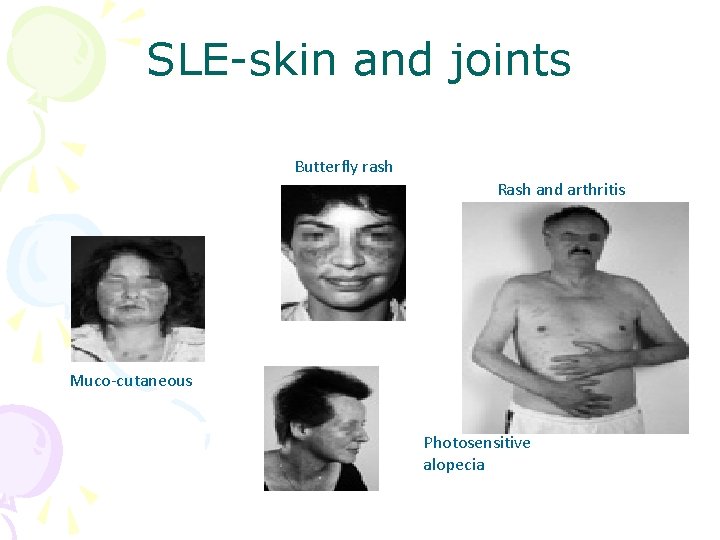 SLE-skin and joints Butterfly rash Rash and arthritis Muco-cutaneous Photosensitive alopecia 