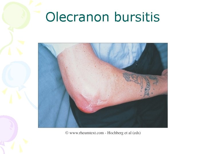 Olecranon bursitis 