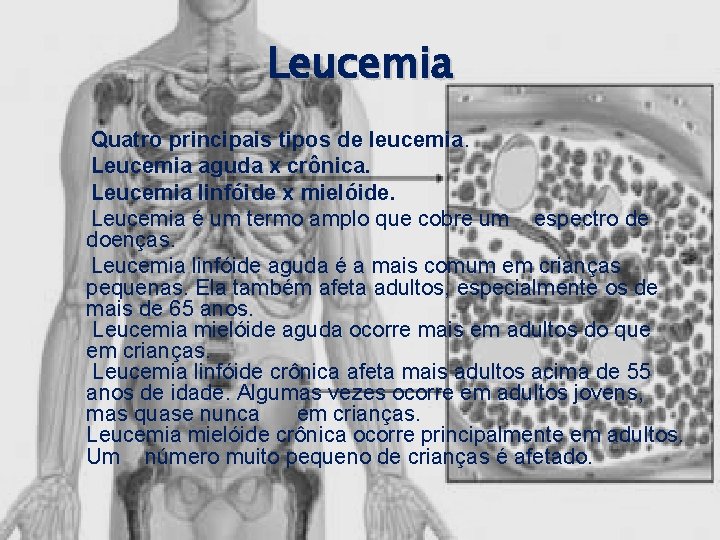Leucemia Quatro principais tipos de leucemia. Leucemia aguda x crônica. Leucemia linfóide x mielóide.
