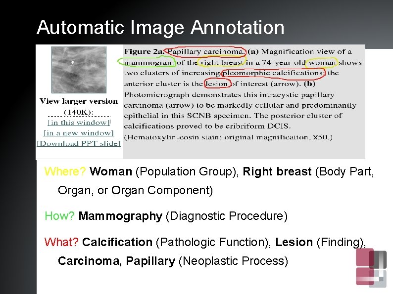 Automatic Image Annotation Where? Woman (Population Group), Right breast (Body Part, Organ, or Organ