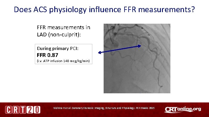 Does ACS physiology influence FFR measurements? FFR measurements in LAD (non-culprit): During primary PCI: