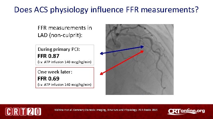 Does ACS physiology influence FFR measurements? FFR measurements in LAD (non-culprit): During primary PCI: