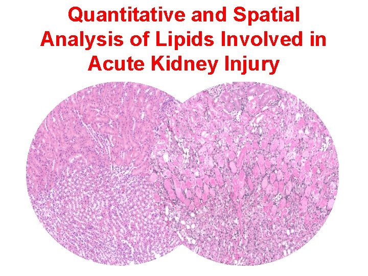 Quantitative and Spatial Analysis of Lipids Involved in Acute Kidney Injury 