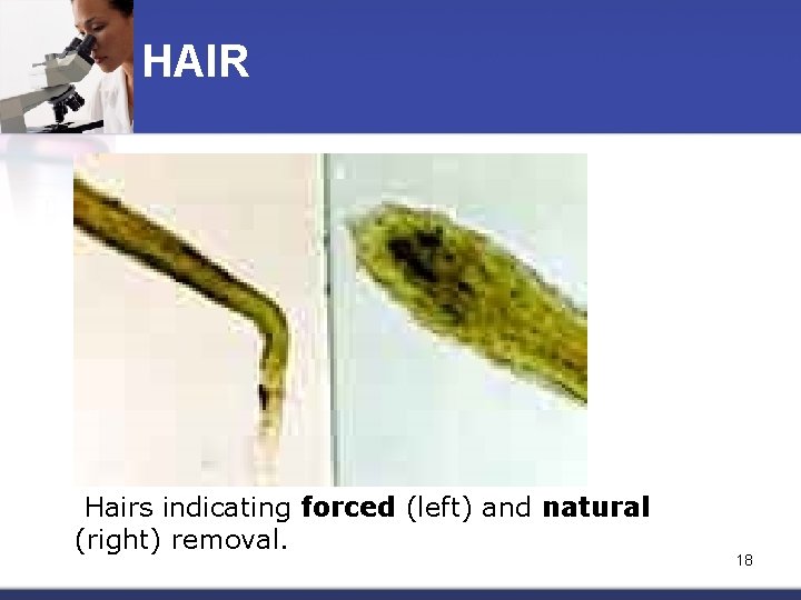 HAIR Hairs indicating forced (left) and natural (right) removal. 18 