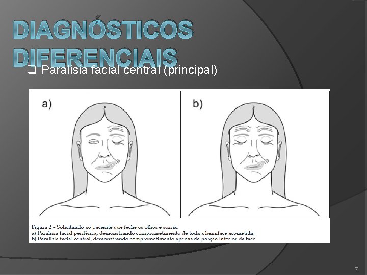 DIAGNÓSTICOS DIFERENCIAIS q Paralisia facial central (principal) 7 