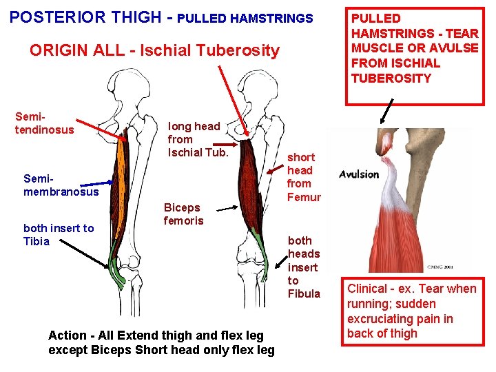 POSTERIOR THIGH - PULLED HAMSTRINGS ORIGIN ALL - Ischial Tuberosity Semitendinosus long head from