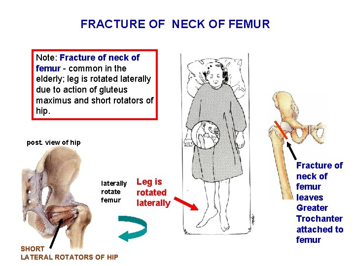 FRACTURE OF NECK OF FEMUR Note: Fracture of neck of femur - common in