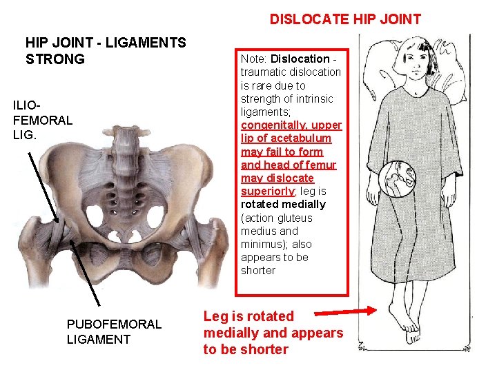 DISLOCATE HIP JOINT - LIGAMENTS STRONG ILIOFEMORAL LIG. PUBOFEMORAL LIGAMENT Note: Dislocation traumatic dislocation