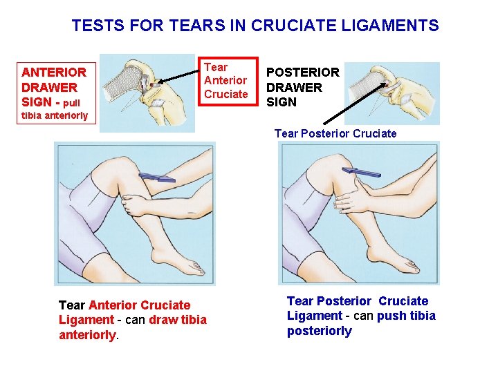 TESTS FOR TEARS IN CRUCIATE LIGAMENTS ANTERIOR DRAWER SIGN - pull Tear Anterior Cruciate
