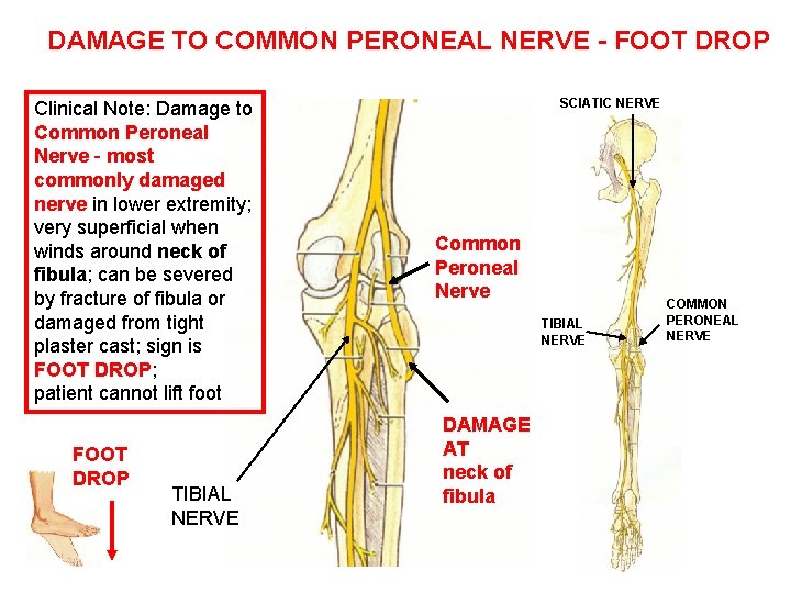 DAMAGE TO COMMON PERONEAL NERVE - FOOT DROP Clinical Note: Damage to Common Peroneal