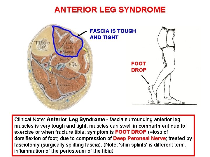 ANTERIOR LEG SYNDROME FASCIA IS TOUGH AND TIGHT FOOT DROP Clinical Note: Anterior Leg