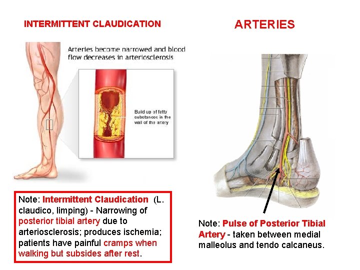 INTERMITTENT CLAUDICATION Note: Intermittent Claudication (L. claudico, limping) - Narrowing of posterior tibial artery