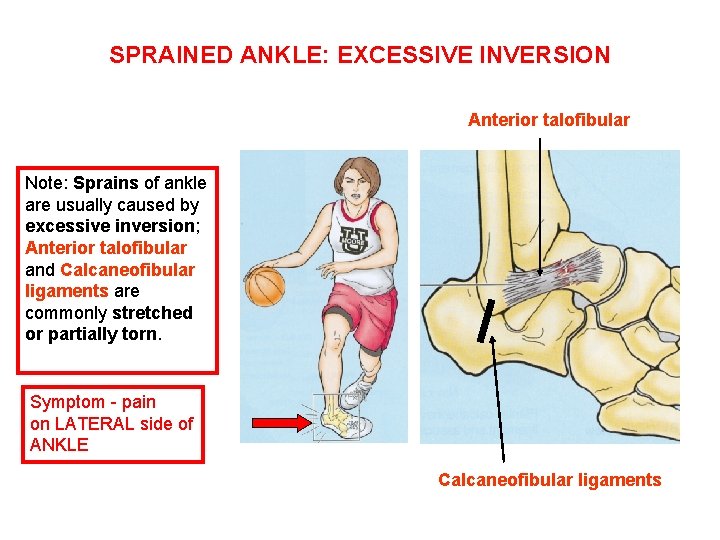 SPRAINED ANKLE: EXCESSIVE INVERSION Anterior talofibular Note: Sprains of ankle are usually caused by