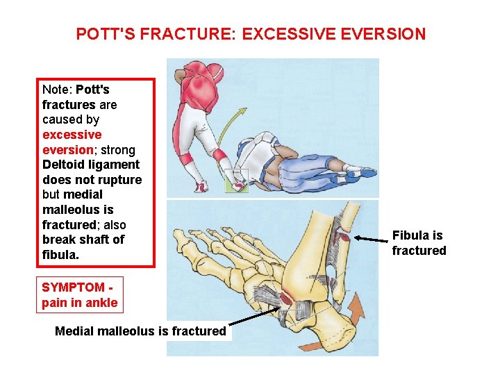POTT'S FRACTURE: EXCESSIVE EVERSION Note: Pott's fractures are caused by excessive eversion; strong Deltoid