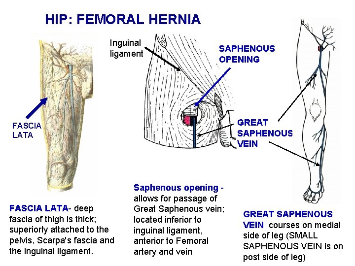 HIP: FEMORAL HERNIA Inguinal ligament SAPHENOUS OPENING GREAT SAPHENOUS VEIN FASCIA LATA- deep fascia