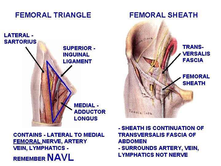 FEMORAL TRIANGLE LATERAL SARTORIUS SUPERIOR INGUINAL LIGAMENT FEMORAL SHEATH TRANSVERSALIS FASCIA FEMORAL SHEATH MEDIAL
