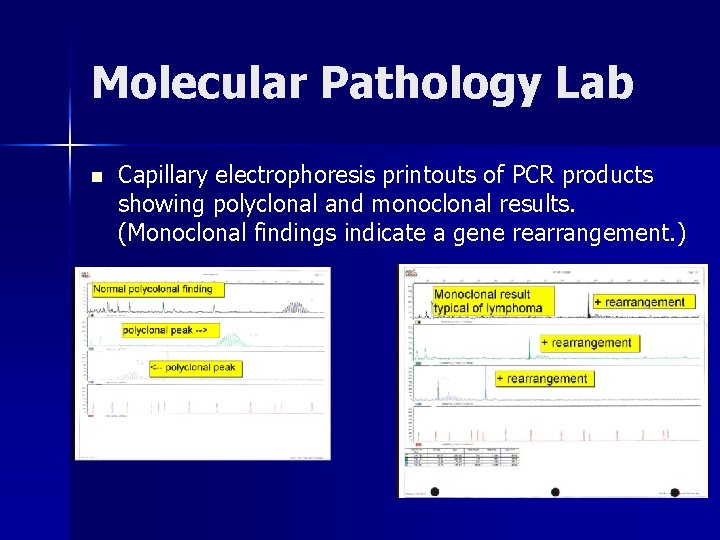 Molecular Pathology Lab n Capillary electrophoresis printouts of PCR products showing polyclonal and monoclonal Molecular Pathology Lab n Capillary electrophoresis printouts of PCR products showing polyclonal and monoclonal