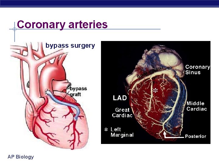 Coronary arteries bypass surgery AP Biology 