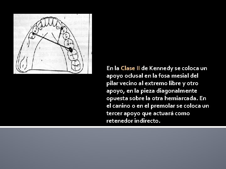 En la Clase II de Kennedy se coloca un apoyo oclusal en la fosa