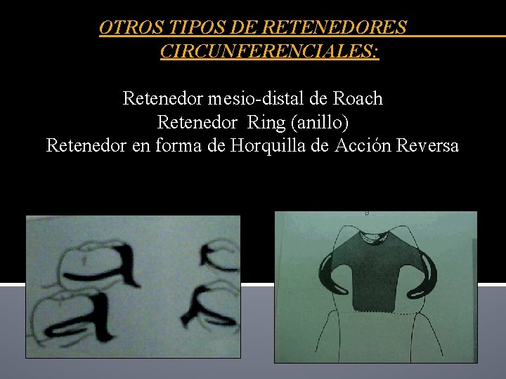 OTROS TIPOS DE RETENEDORES CIRCUNFERENCIALES: Retenedor mesio-distal de Roach Retenedor Ring (anillo) Retenedor en