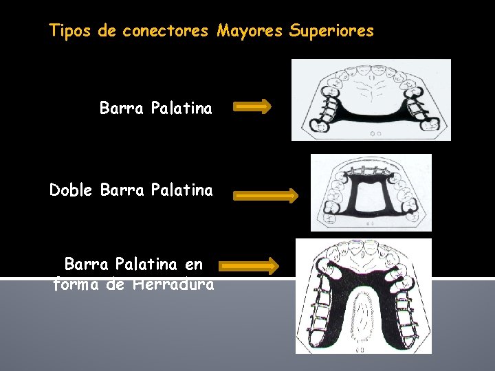 Tipos de conectores Mayores Superiores Barra Palatina Doble Barra Palatina en forma de Herradura