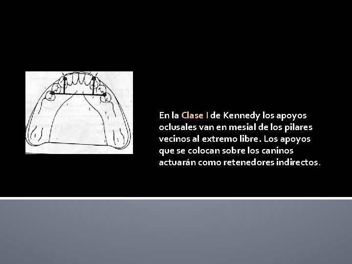 En la Clase I de Kennedy los apoyos oclusales van en mesial de los